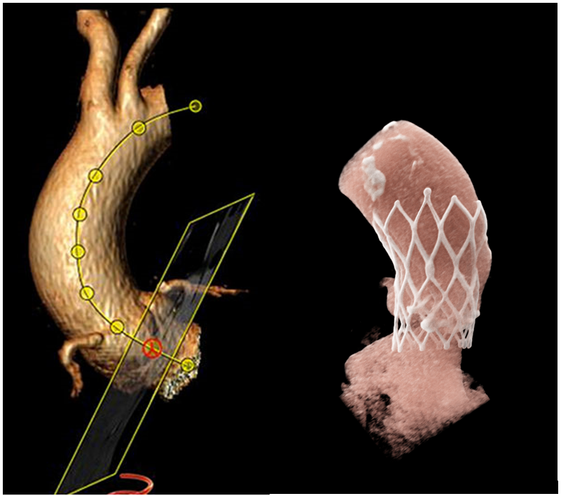 3D Darstellung der CT-Angiographie einer Aorta ascendens zur Planung (links) und zur Verlaufskontrolle (rechts) einer minimal-invasiven Klappenintervention (TAVI).