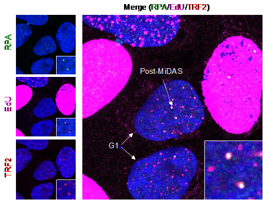 Evidence for single-stranded DNA (marked by the RPA signal in green) and DNA synthesis (EdU signal in magenta) at telomeres (marked by the telomeric protein TRF2 in red) in newly born G1 cells. Such post-mitotic DNA synthesis (post-MiDAS) occurs in response to DNA replication stress, particularly in cancer cells that have activated alternative lengthening of telomeres to achieve replicative immortality. 