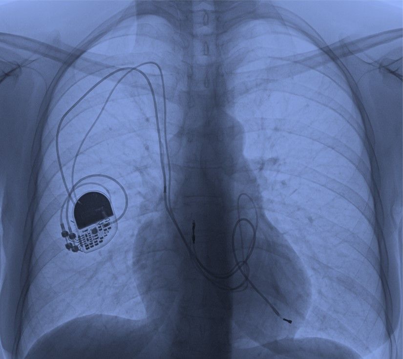 Röntgenbild Elektrodenextraktion