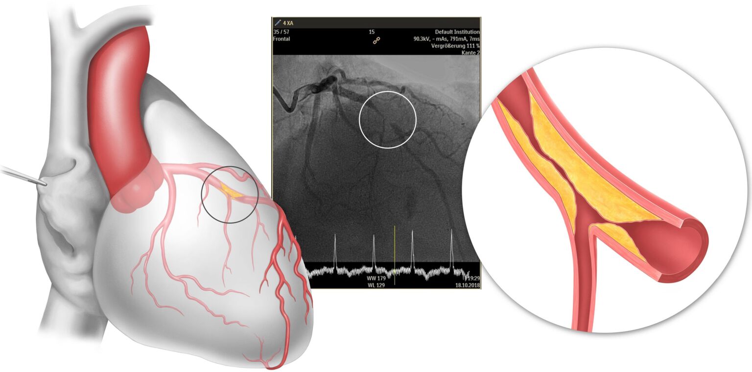perkutaner-koronarer-herzkatheter-und-interventionen-ballon-dilatation