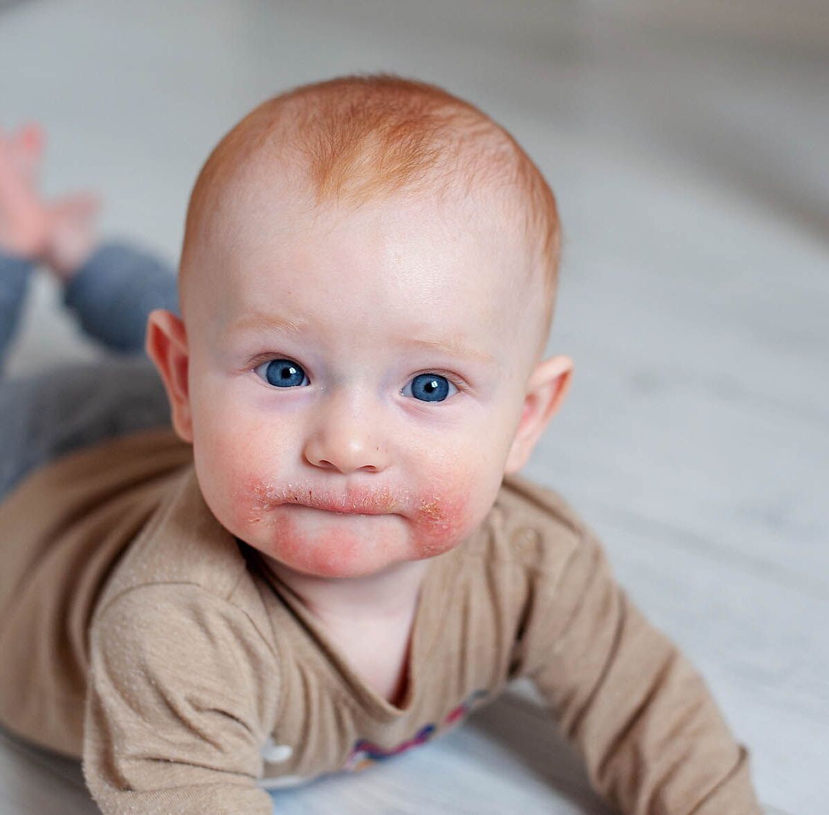 Baby mit Neurodermitis im Gesicht