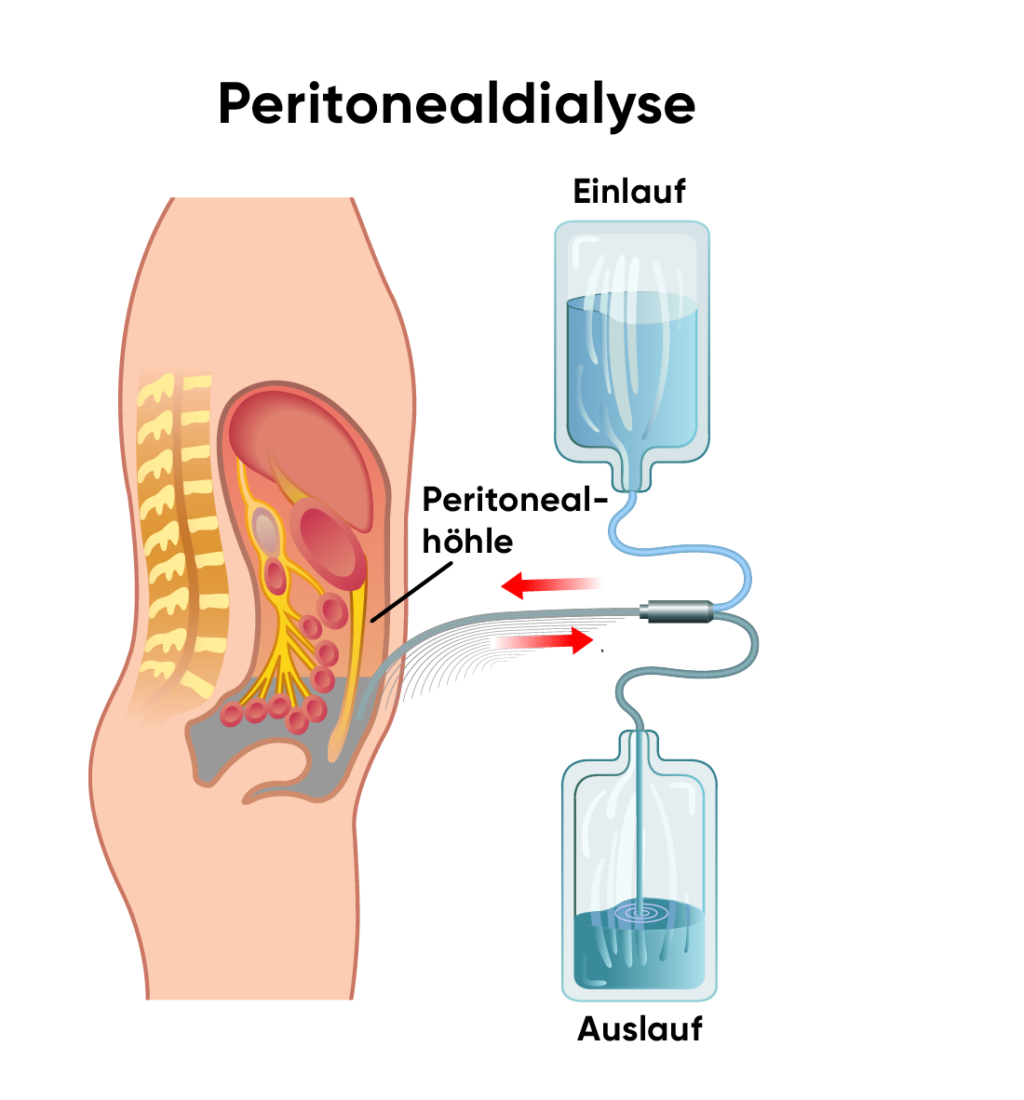 Illustration Ablauf Peritonealdialyse