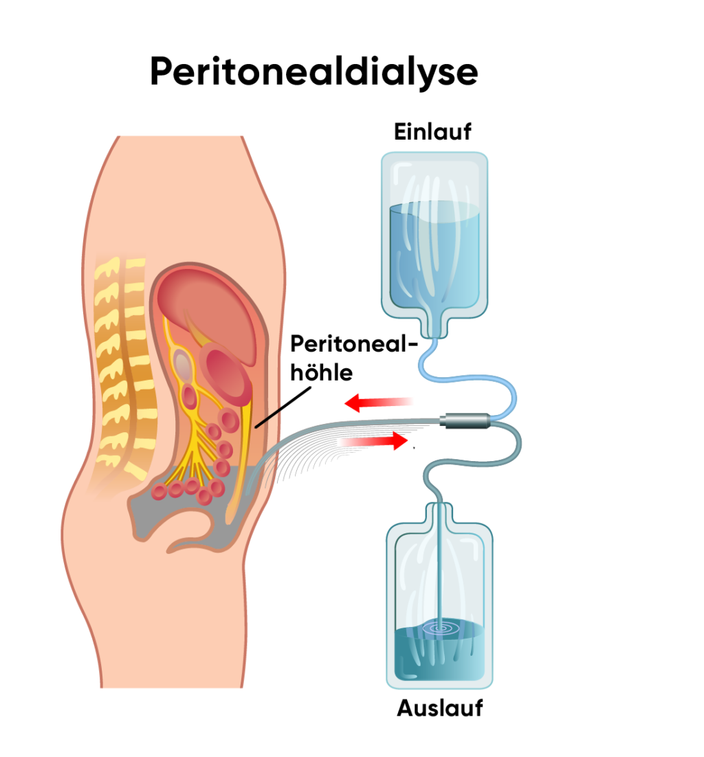 Illustration of the peritoneal dialysis procedure