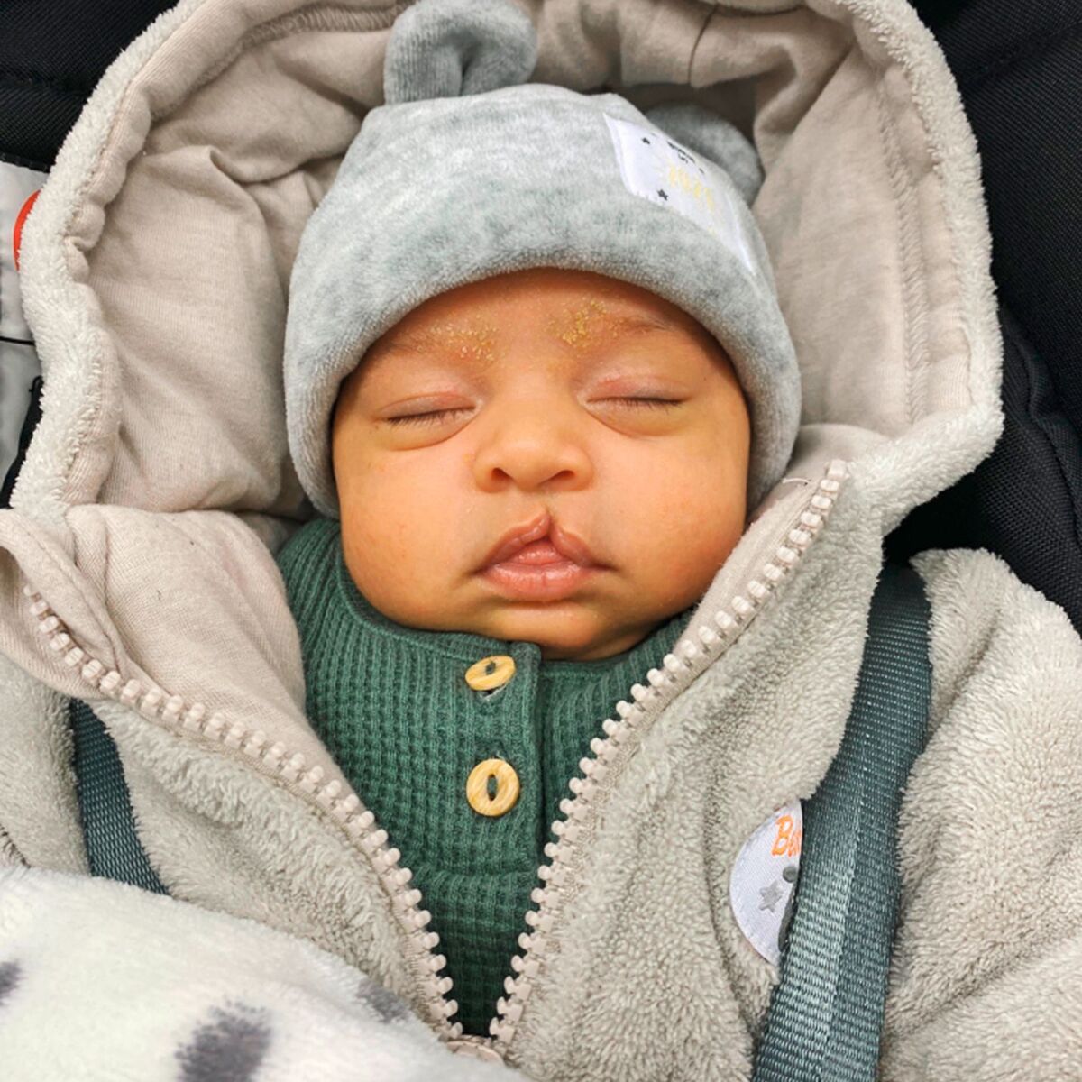 Baby mit Lippen-, Kiefer- Gaumenspalte