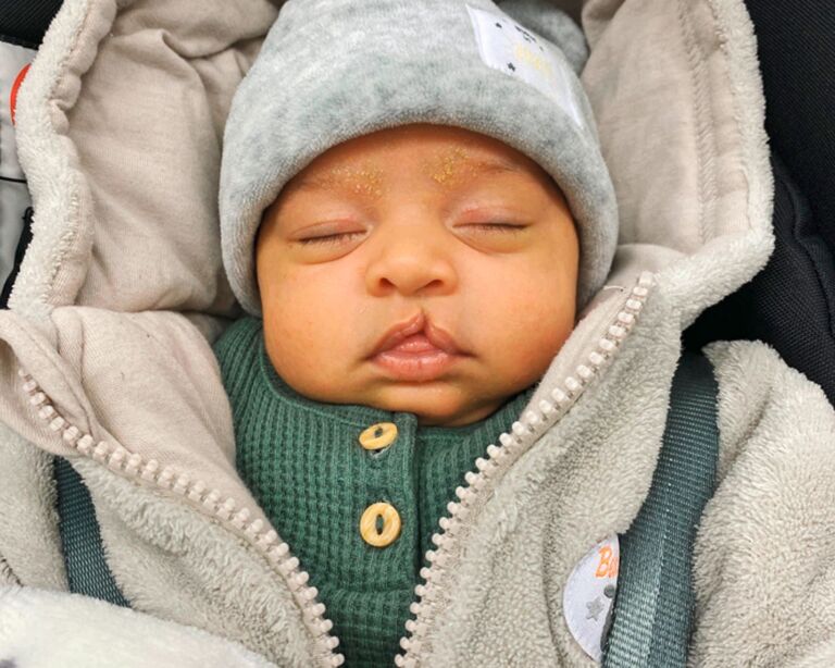 Baby mit Lippen-, Kiefer- Gaumenspalte