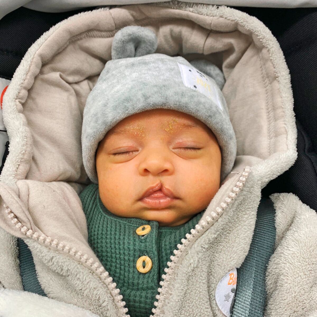 Baby mit Lippen-, Kiefer- Gaumenspalte