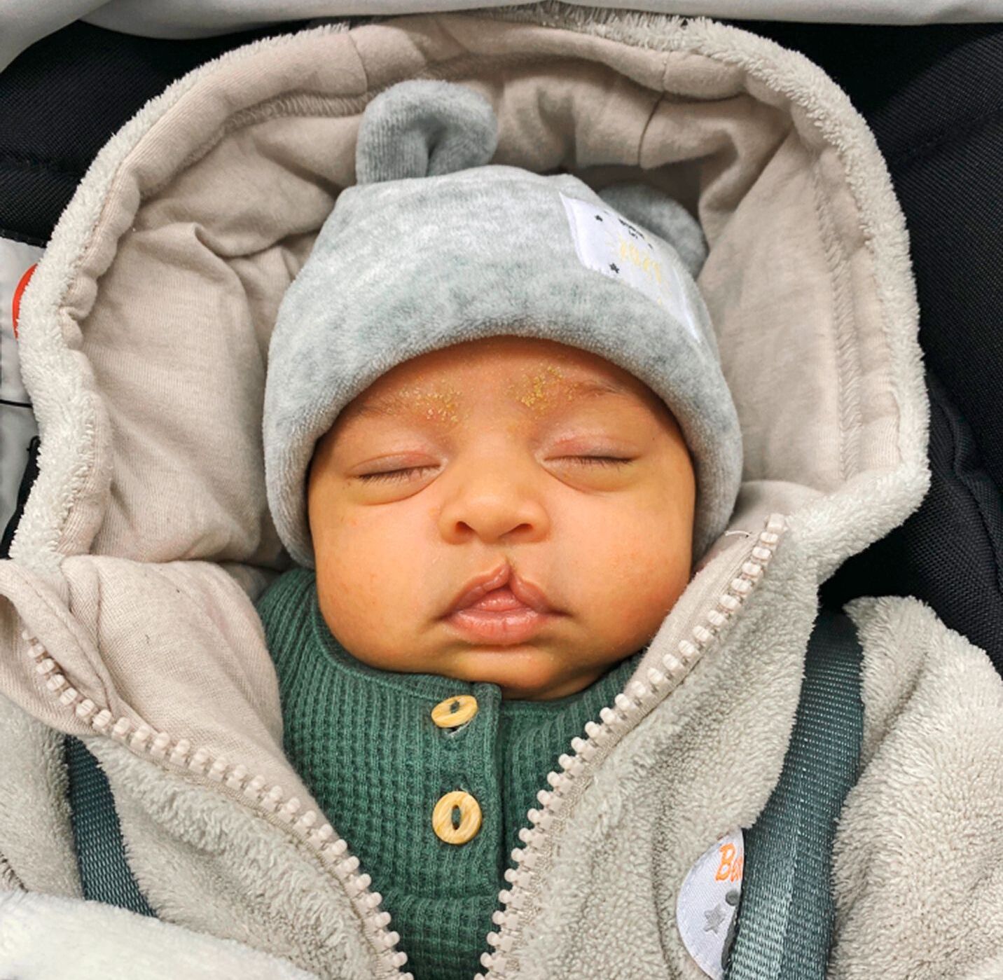 Baby mit Lippen-, Kiefer- Gaumenspalte