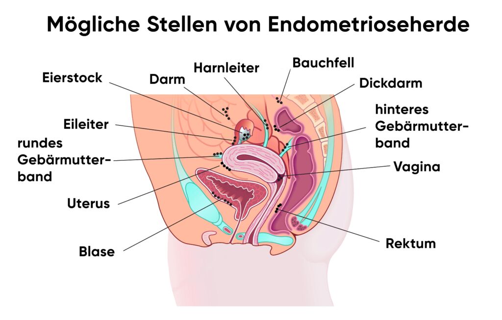 Illustration Organe und Endometrioseherde
