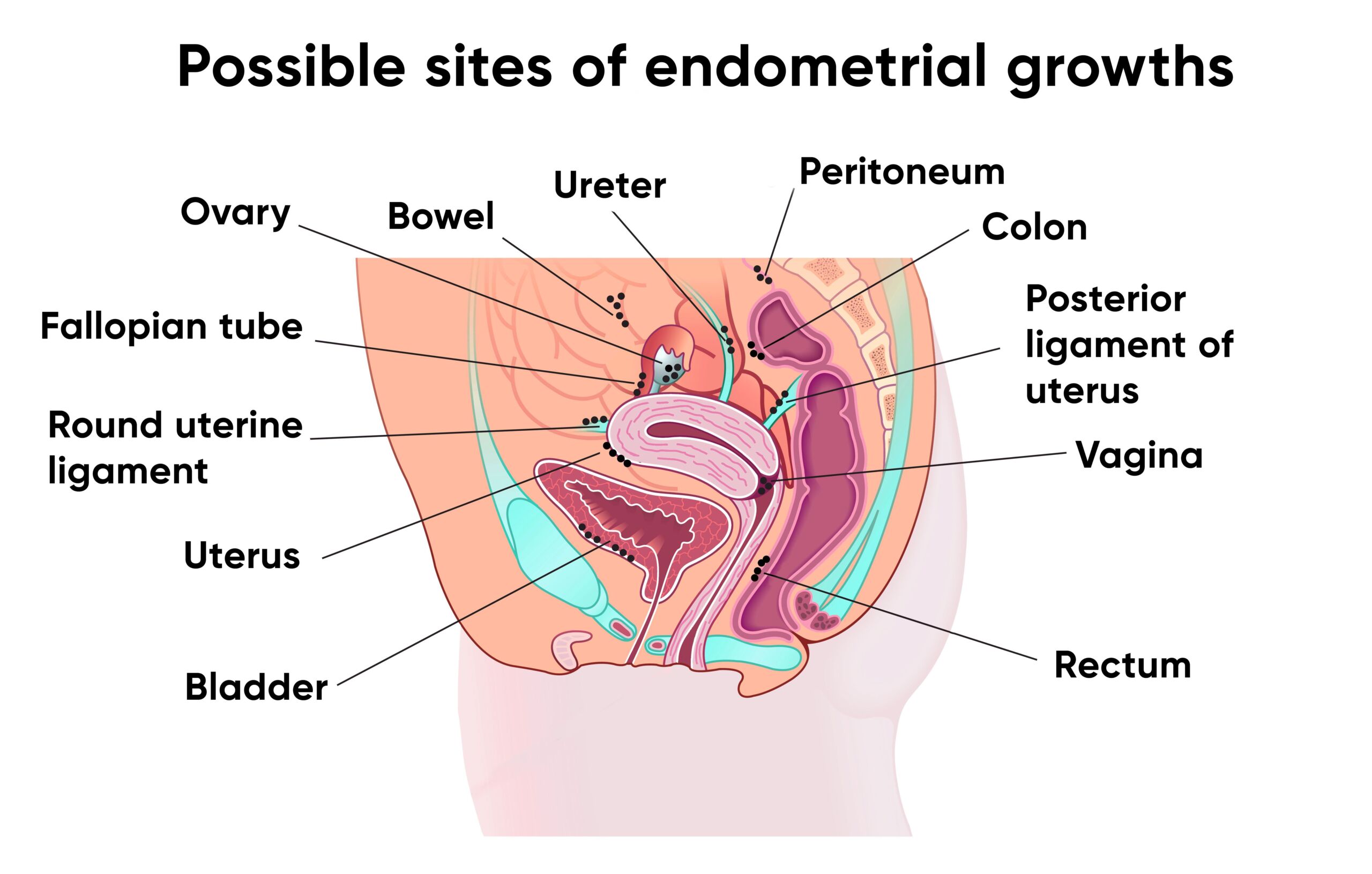 Illustration organs and endometriosis lesions