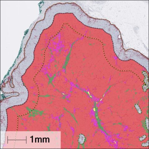 AI-based segmentation of melanoma metastases in a tumor