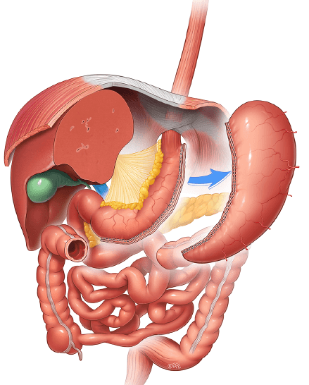 Grafik einer Schlauchmagenoperation