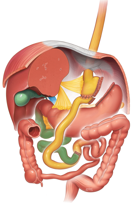 Grafik einer Roux En Y Opertation