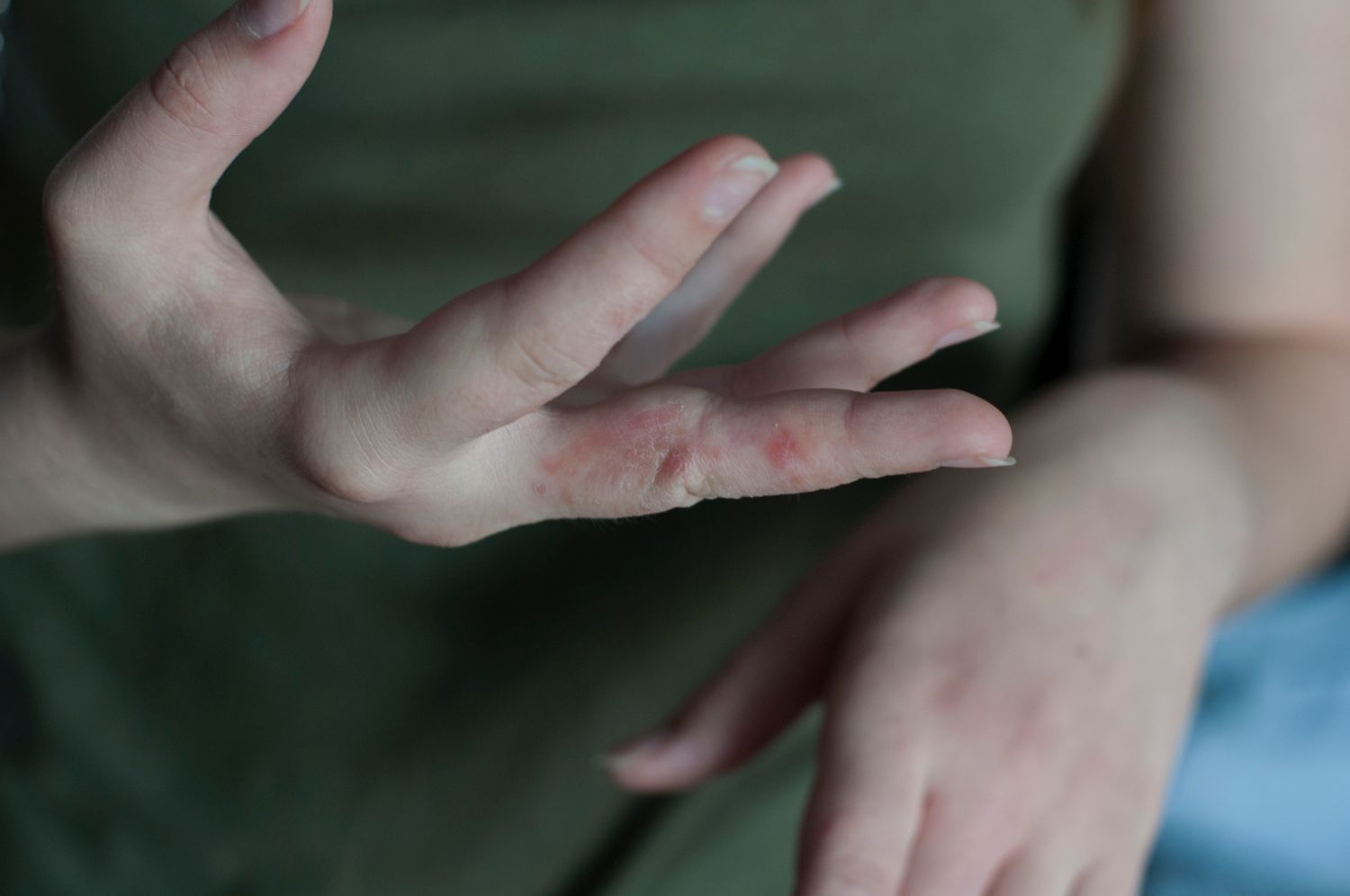 Frauenhand mit Hautveränderung an den Fingern