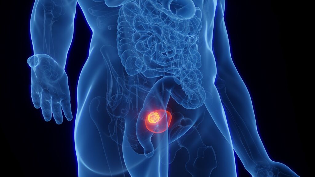 Illustration einer männlichen Blase mit einem Tumor