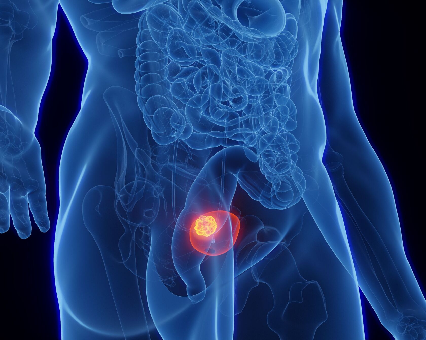 Illustration einer männlichen Blase mit einem Tumor
