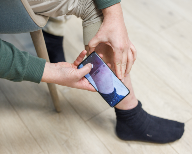 Mann fotografiert Haut am Bein mit Handy