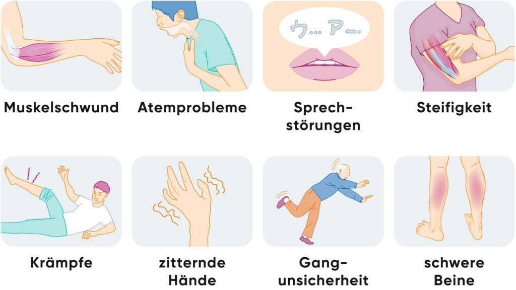 Illustrationen zu Symptomen bei ALS