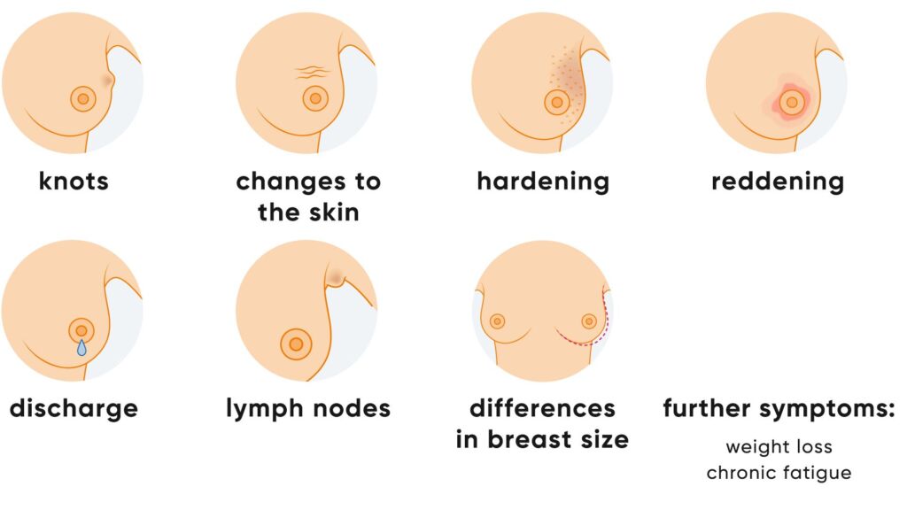 Illustration von Symptomen bei Brustkrebs