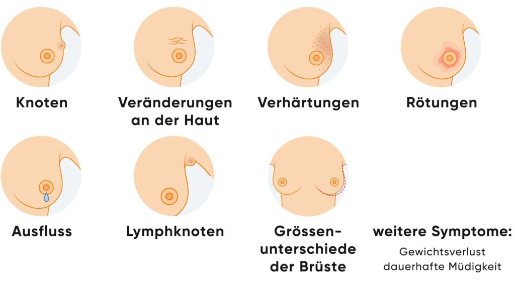 Illustration von Symptomen bei Brustkrebs