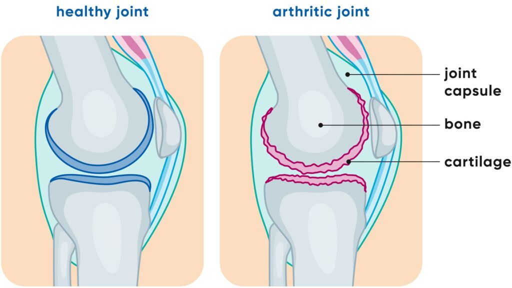 Illustration von einem gesunden und einem arthritischen Gelenk