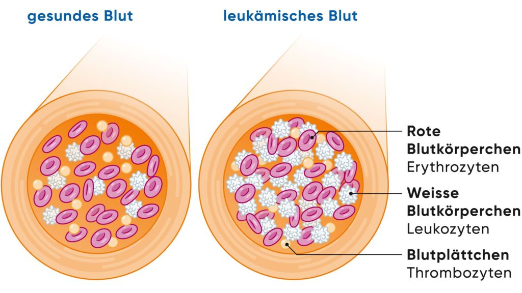 Illustration von gesundem Blut und Blut mit Leukämie