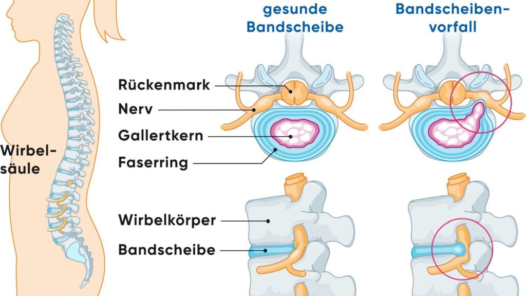 Illustration Bandscheibenvorfall