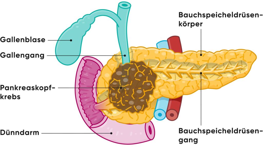 Illustration Krebs im Kopf der Bauchspeicheldrüse