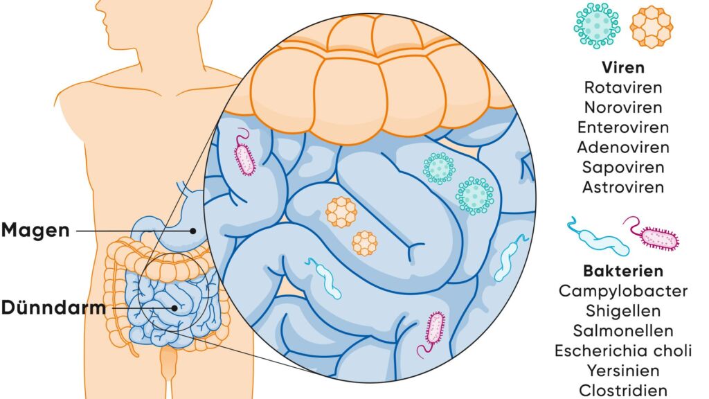 Illustration Magen Darm Grippe Viren und Bakterien