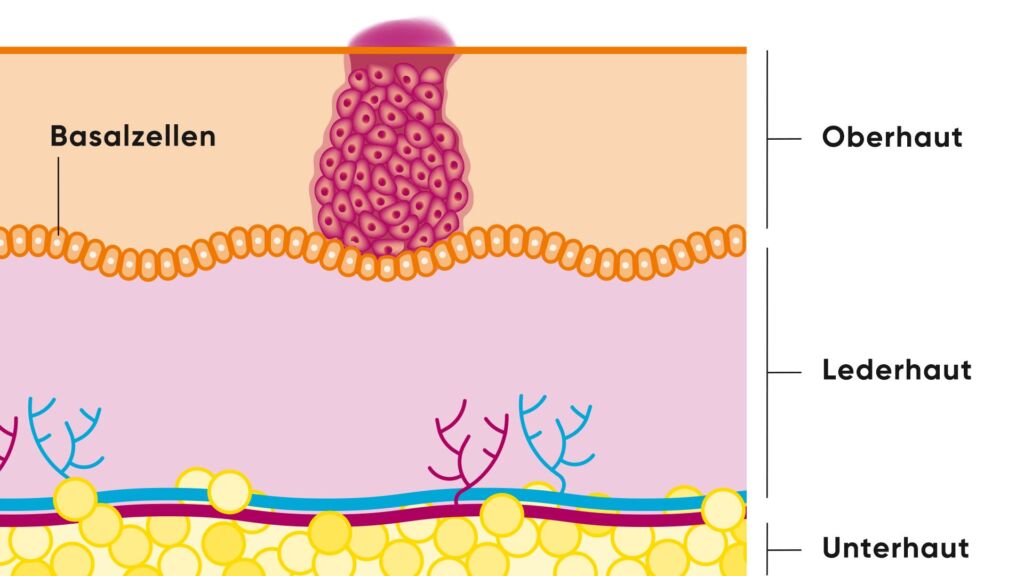 Illustration Basalzellkarzinom in der Ober-, Leder- und Unterhaut