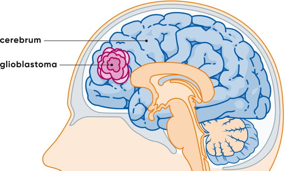 Illustration Hirn und Lage von Glioblastom