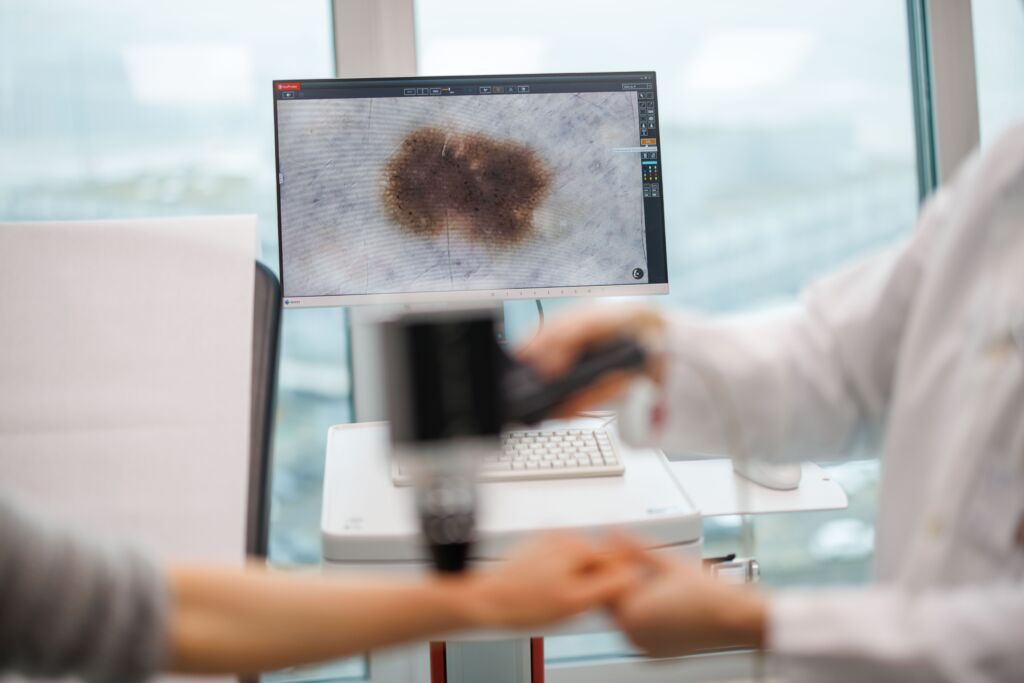 Bildschirm mit vergrössertem Muttermal