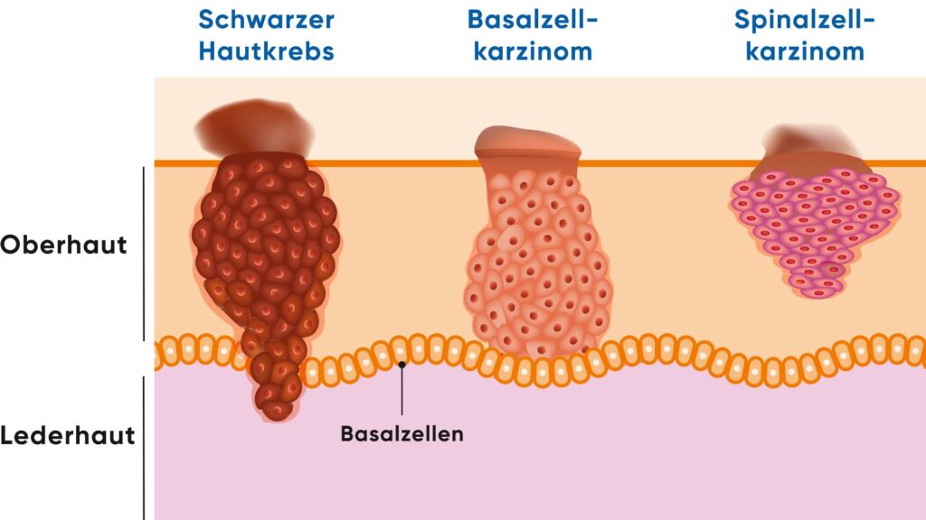 Illustration Unterscheid Schwarzer Hautkrebs, Basalzellkarzinom und Spinalzellkarzinom