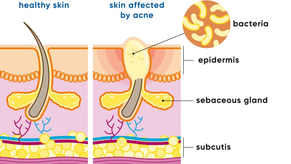 Illustration gesunde und von Akne betroffene Haut