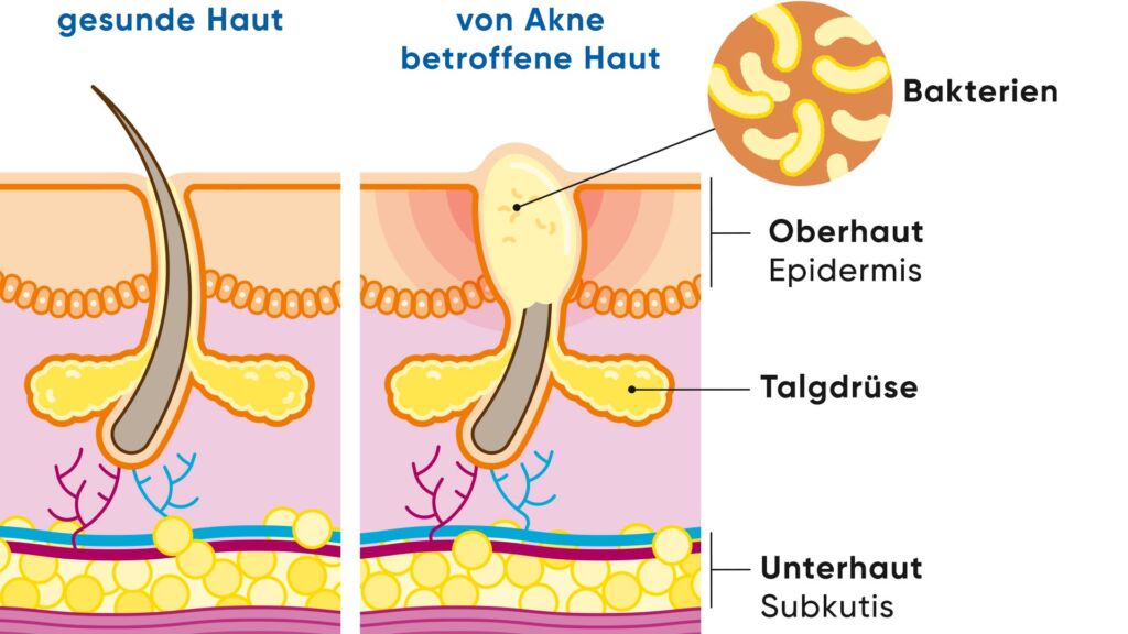 Illustration gesunde und von Akne betroffene Haut