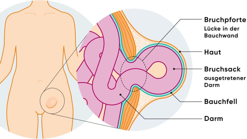 Illustration Leistenbruch