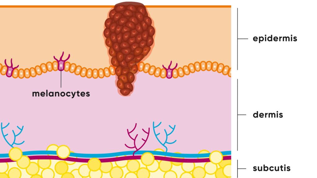 Illustration Malignes Melanom