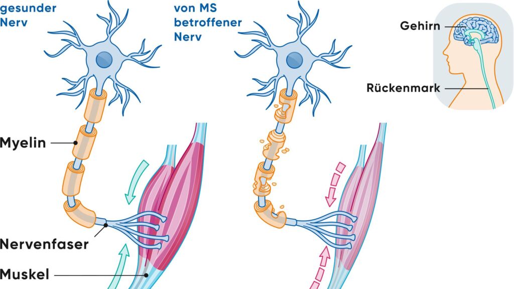 Illustration betroffener und gesunder Nerv bei Multipler Sklerose