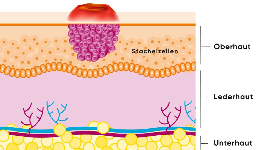 Illustration eines Spinalioms