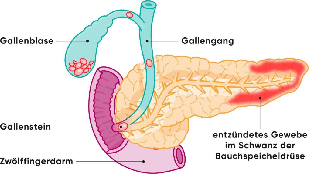 Illustration einer entzündeten Bauchspeicheldrüse