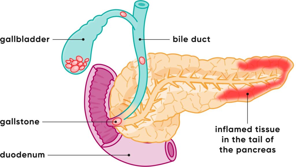 Illustration einer entzündeten Bauchspeicheldrüse
