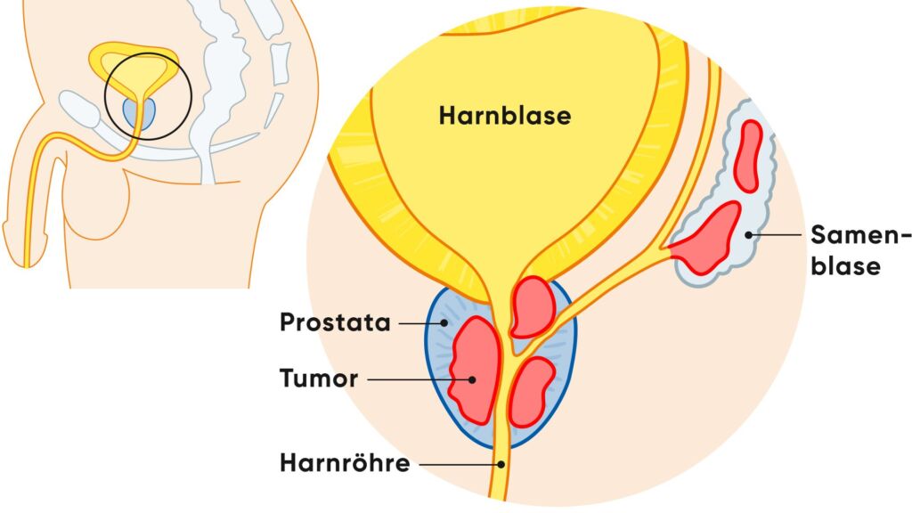Illustration Prostata Detail und Prostatatumor