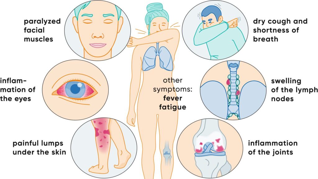 Illustration Symptome Sarkoidose