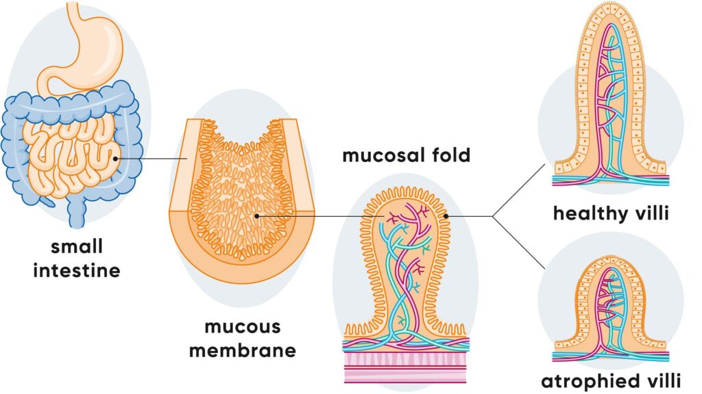 Illustration gesunde und atrophierte Zotten bei Zöliakie