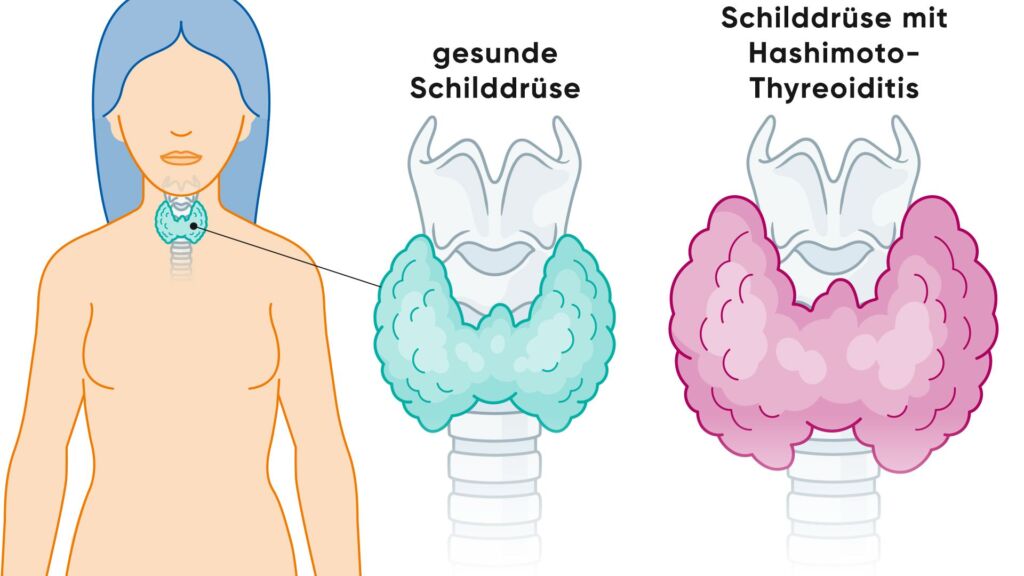 Illustration vergrösserte Schilddrüse bei Hashimoto-Thyreoiditis