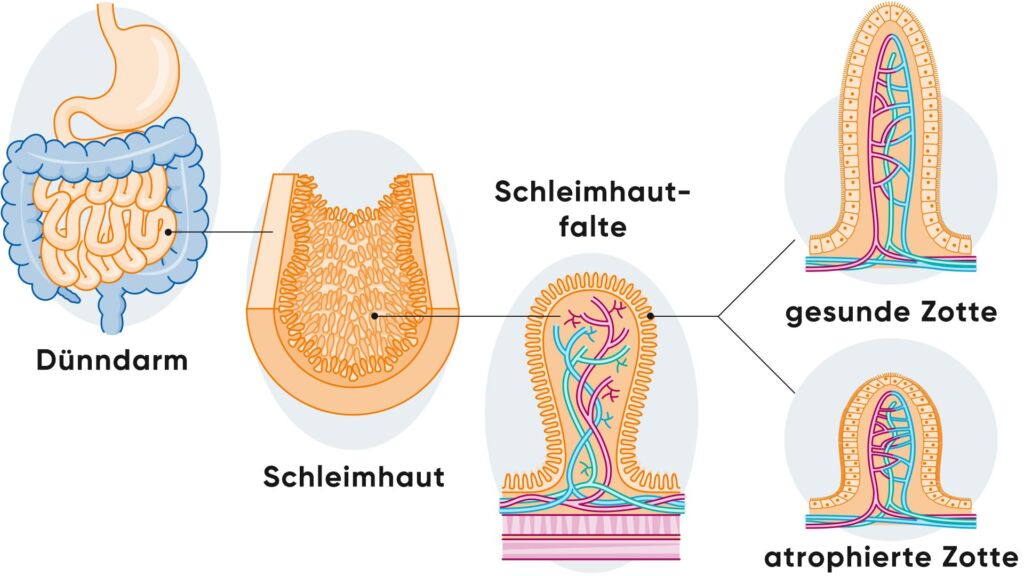 Illustration gesunde und atrophierte Zotten bei Zöliakie