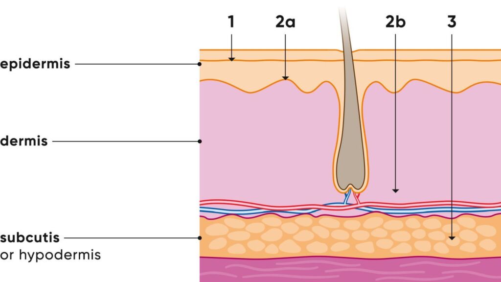 Illustration Verbrennungsgrade 1-3 auf der Haut