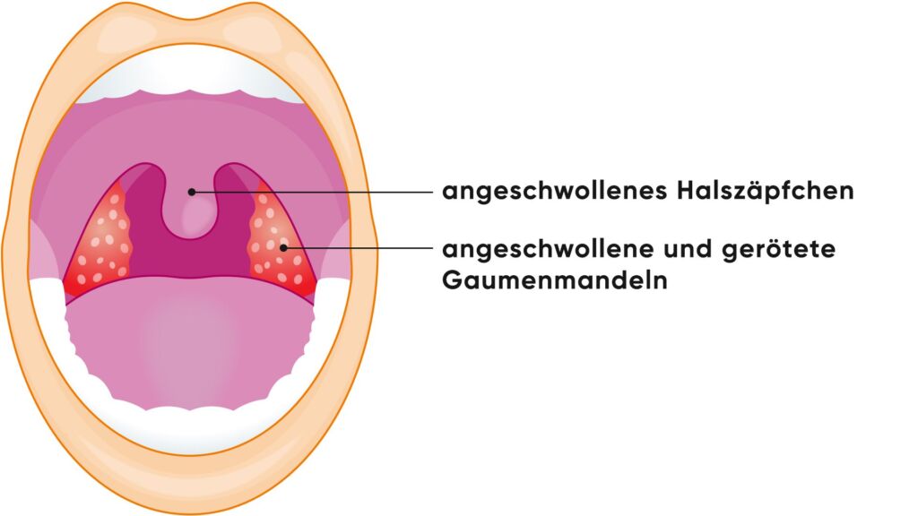 Illustration Entzündung Mandel Angina