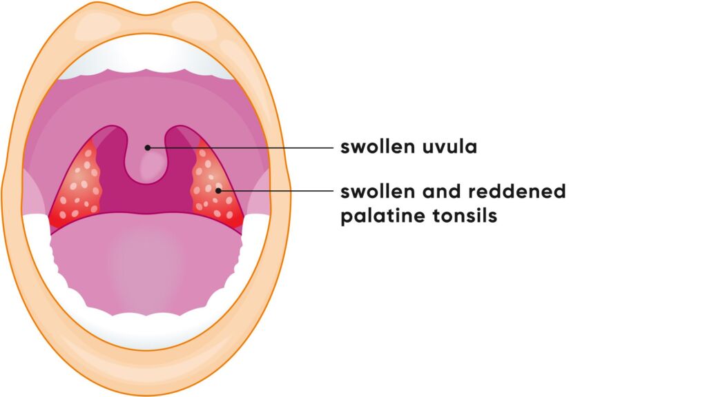 Illustration Entzündung Mandel Angina