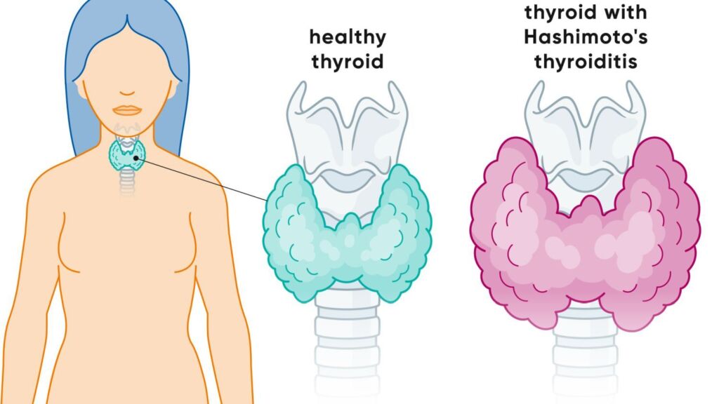 Illustration vergrösserte Schilddrüse bei Hashimoto-Thyreoiditis