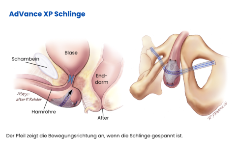 Illustration einer AdVance XP Schlinge